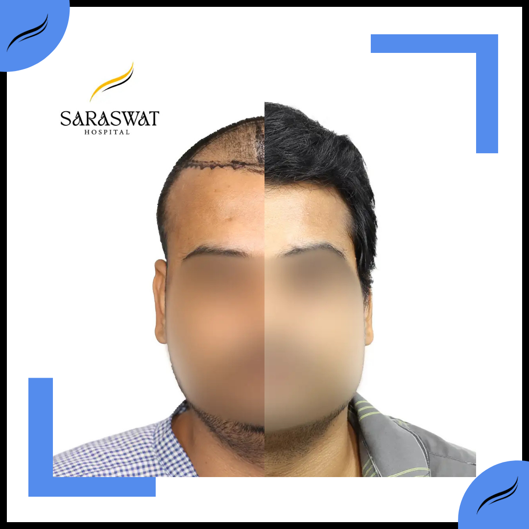 Hair Transplant Before and After