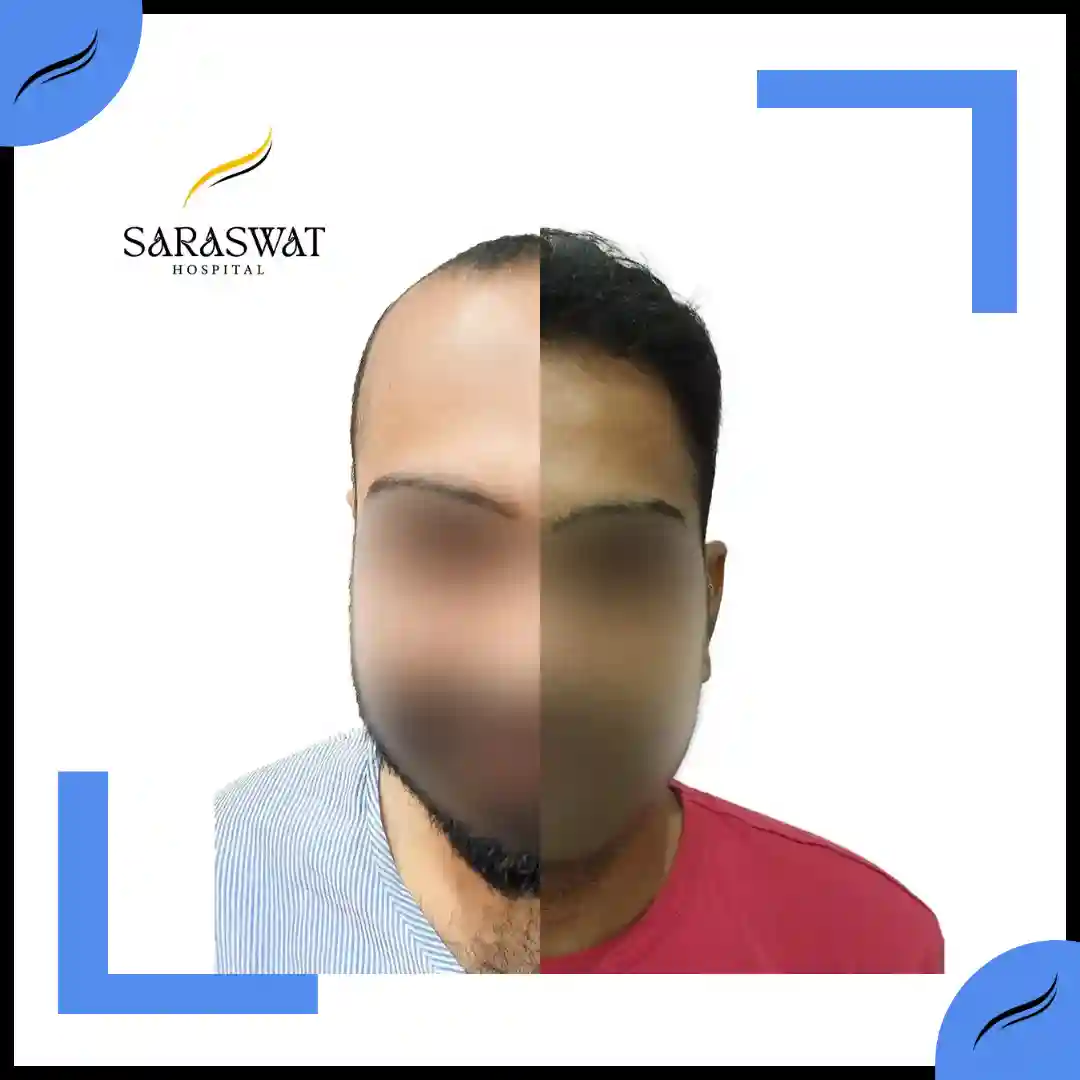 Hair Transplant Before and After