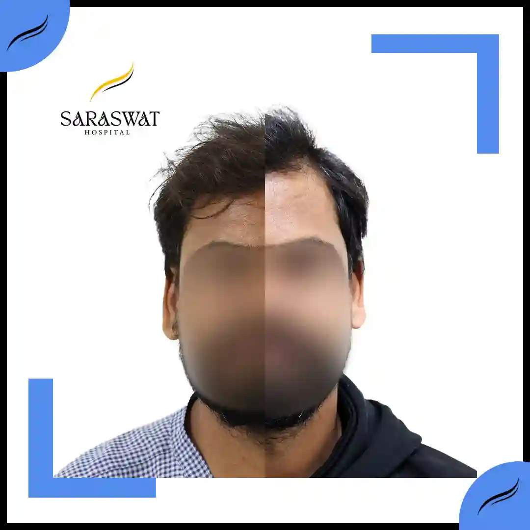 Hair Transplant Before and After