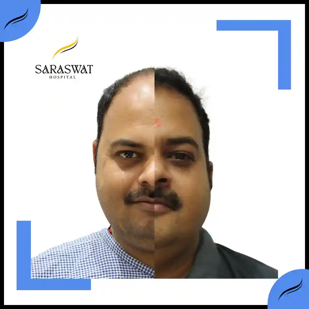 Hair Transplant Before and After