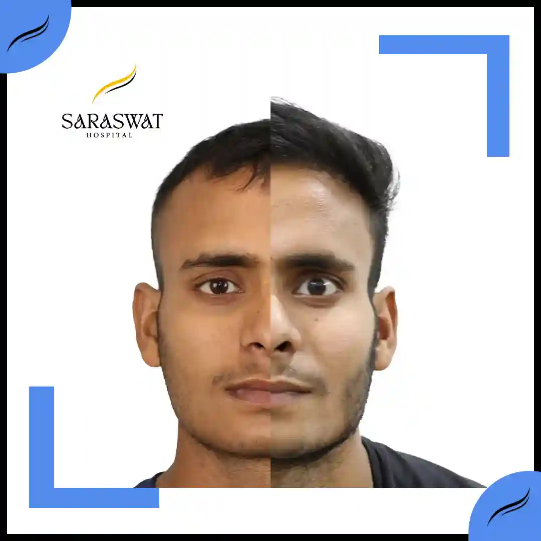 Hair Transplant Before and After