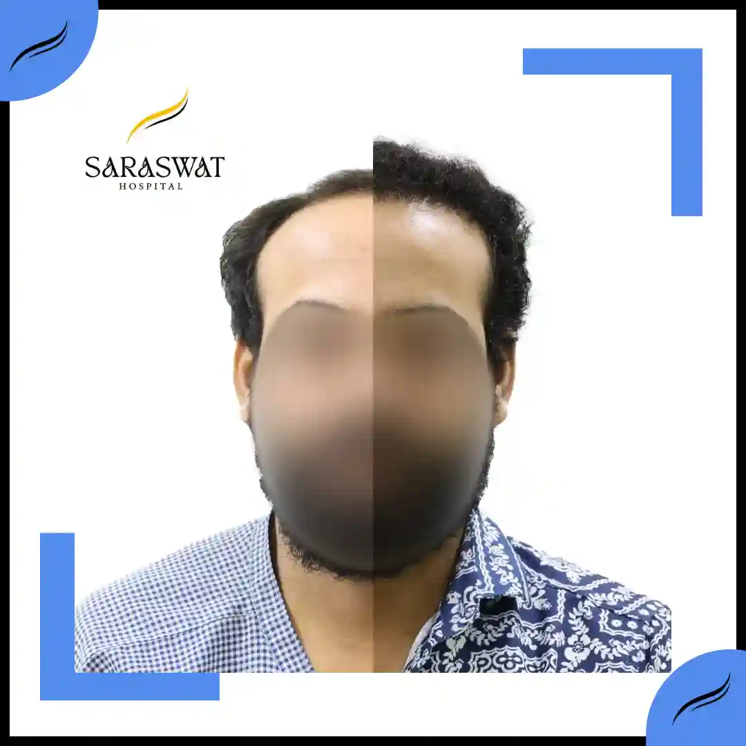 Hair Transplant Before and After