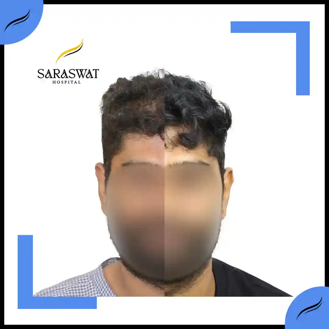 Hair Transplant Before and After Results | Hair Transplant Results