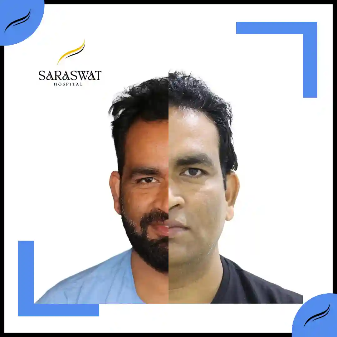 Hair Transplant Before and After