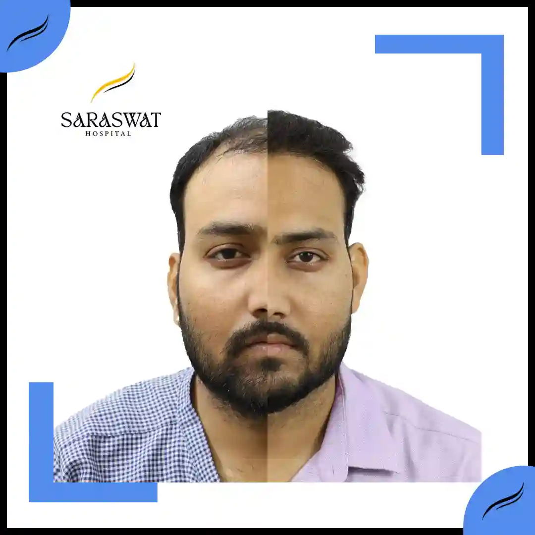 Hair Transplant Before and After