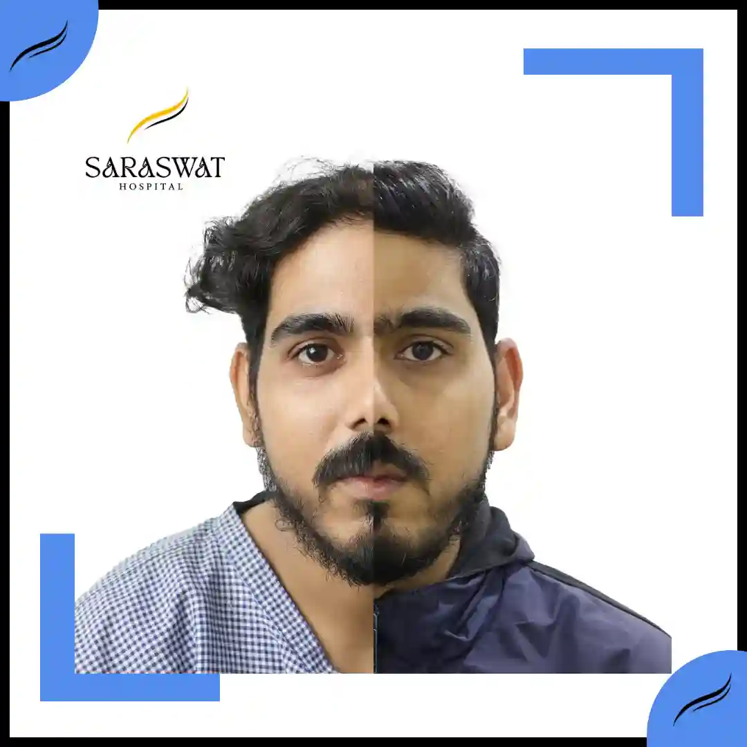 Hair Transplant Before and After