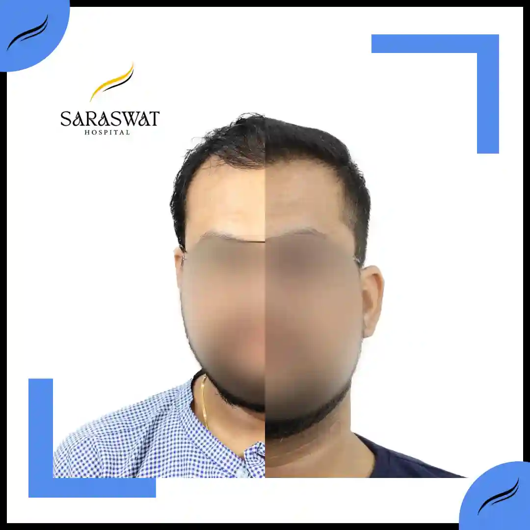 Hair Transplant Before and After