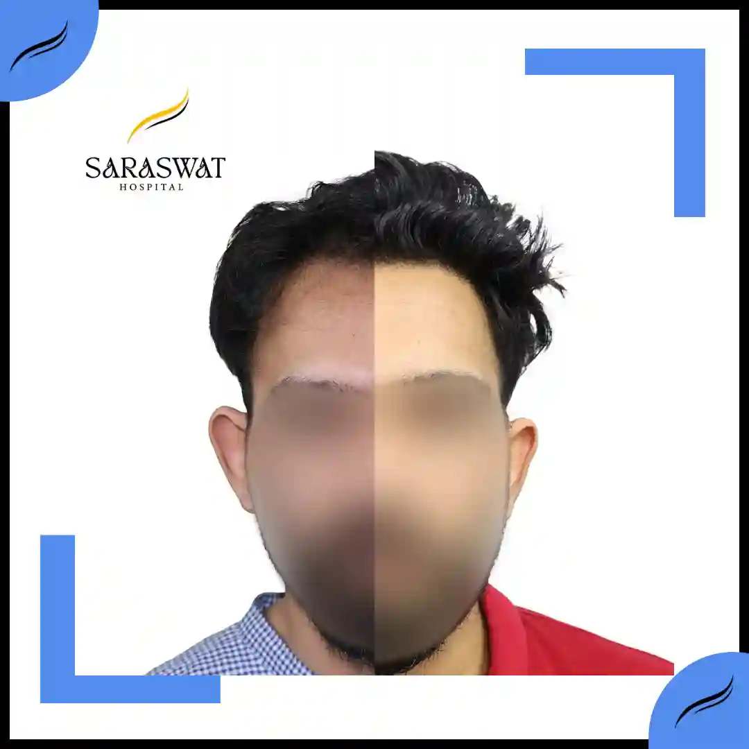 Hair Transplant Before and After