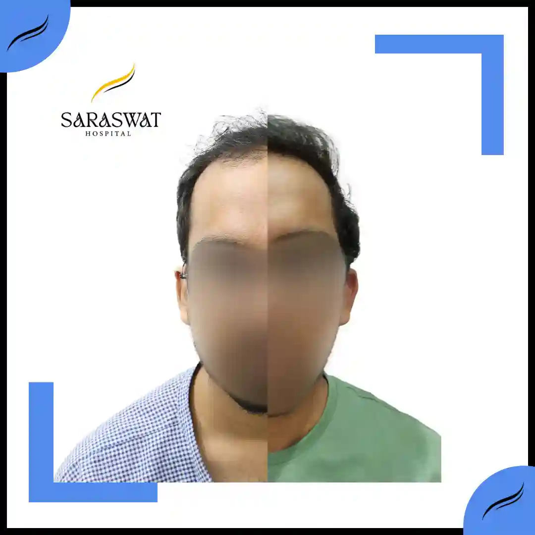 Grade 4 Hair Transplant Result