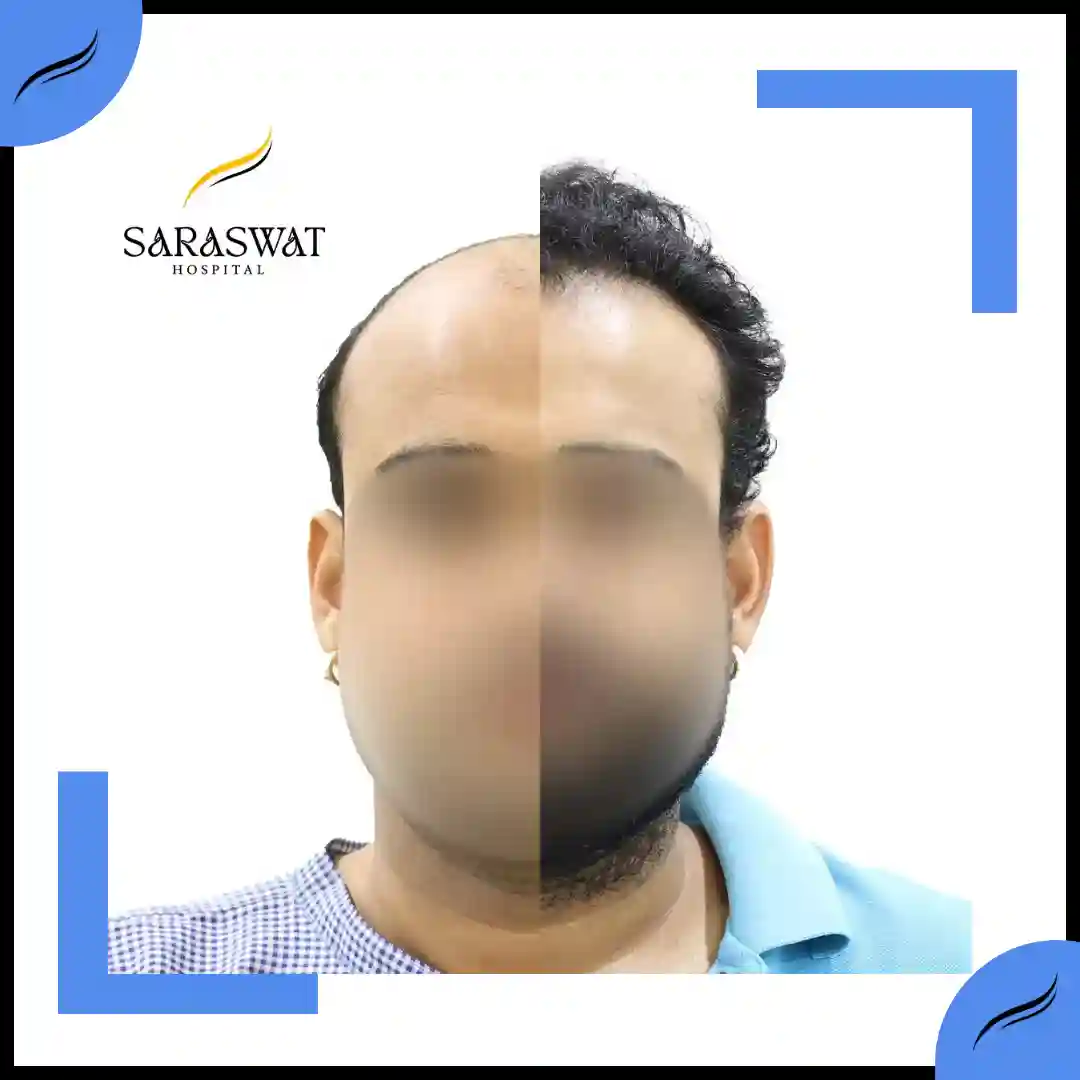 Hair Transplant Before and After