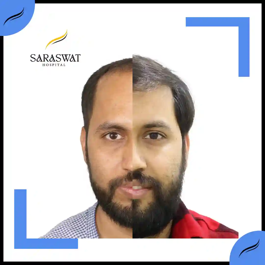 Hair Transplant Before and After