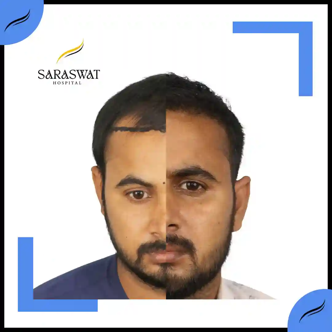Hair Transplant Before and After