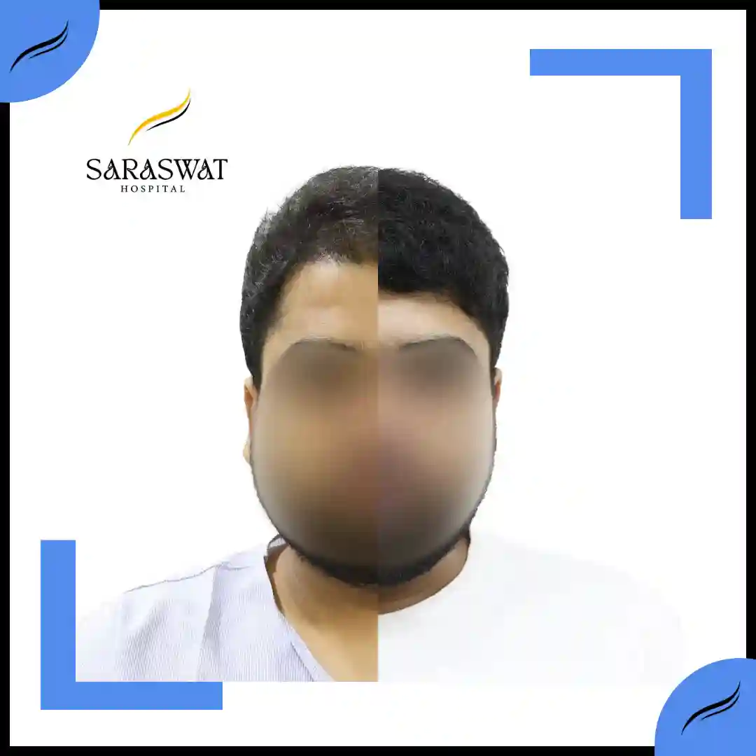 Hair Transplant Before and After