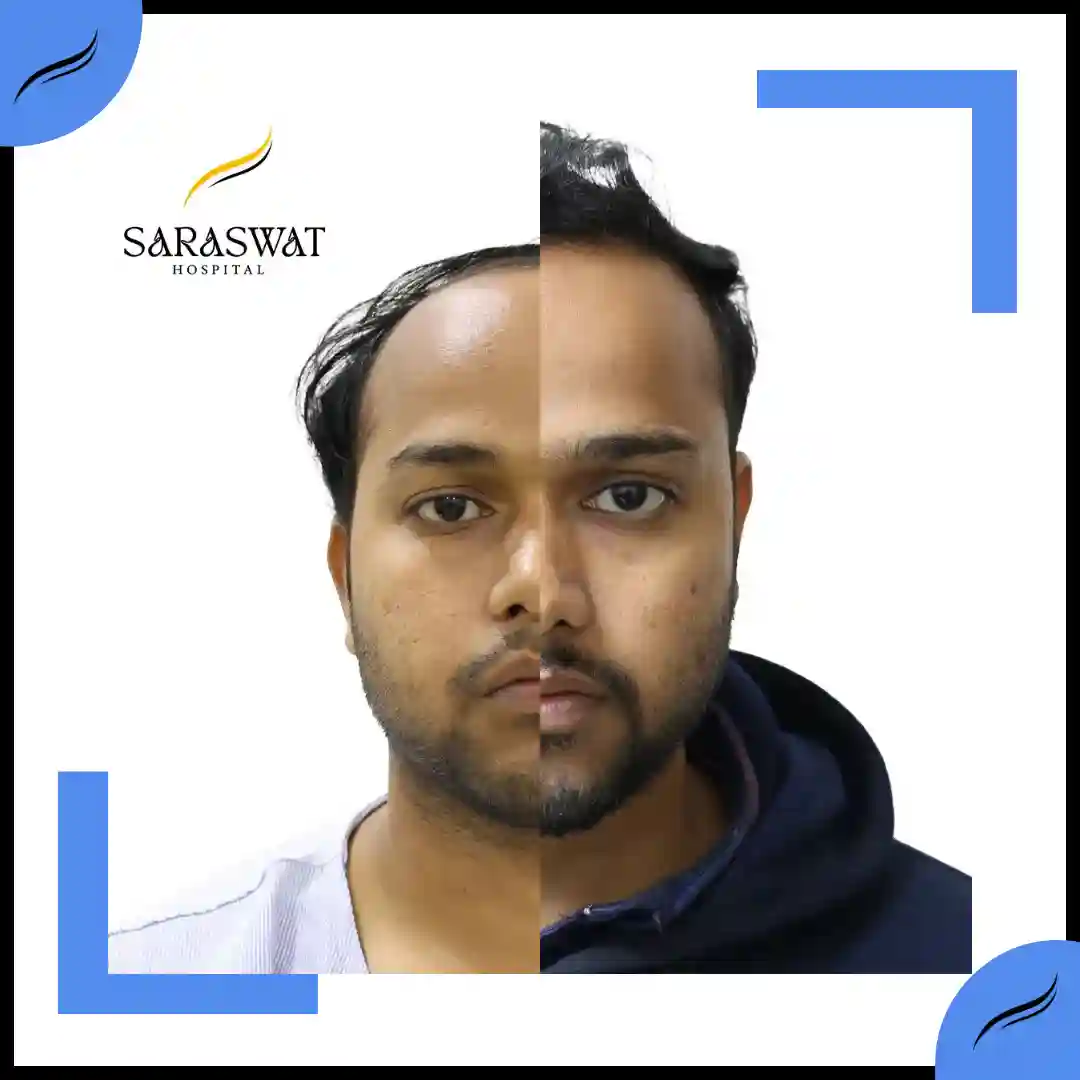 Hair Transplant Before and After