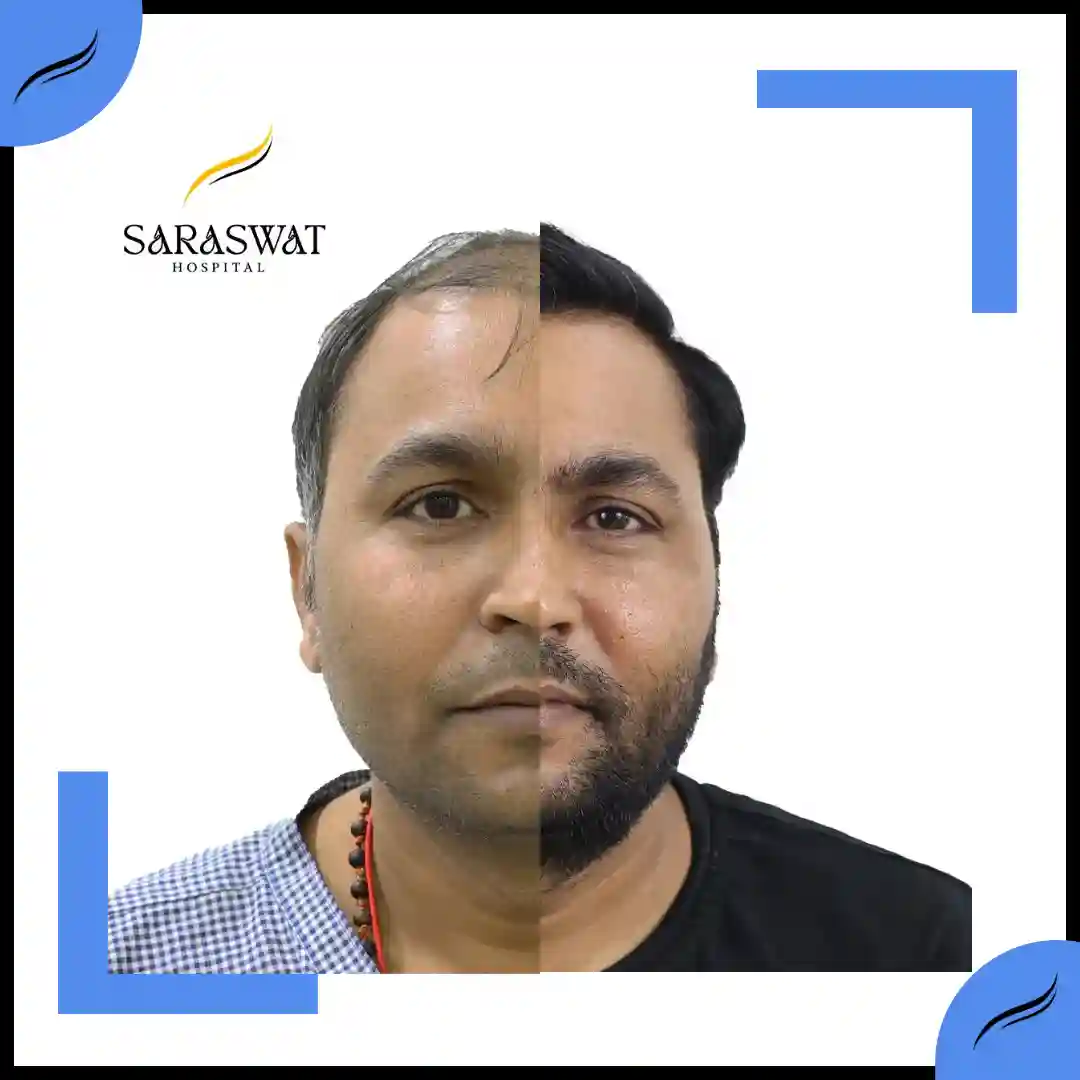 Hair Transplant Before and After