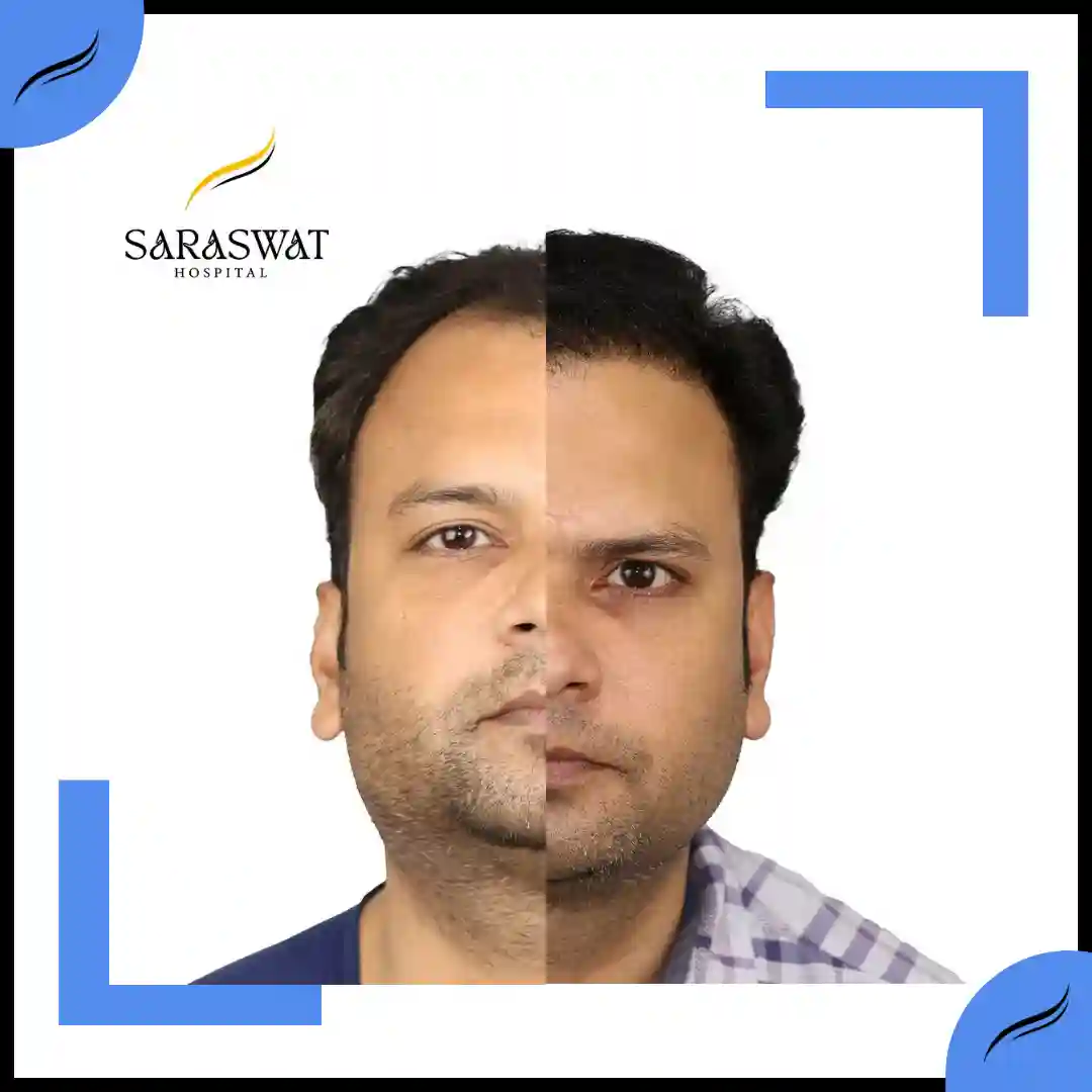 Hair Transplant Before and After