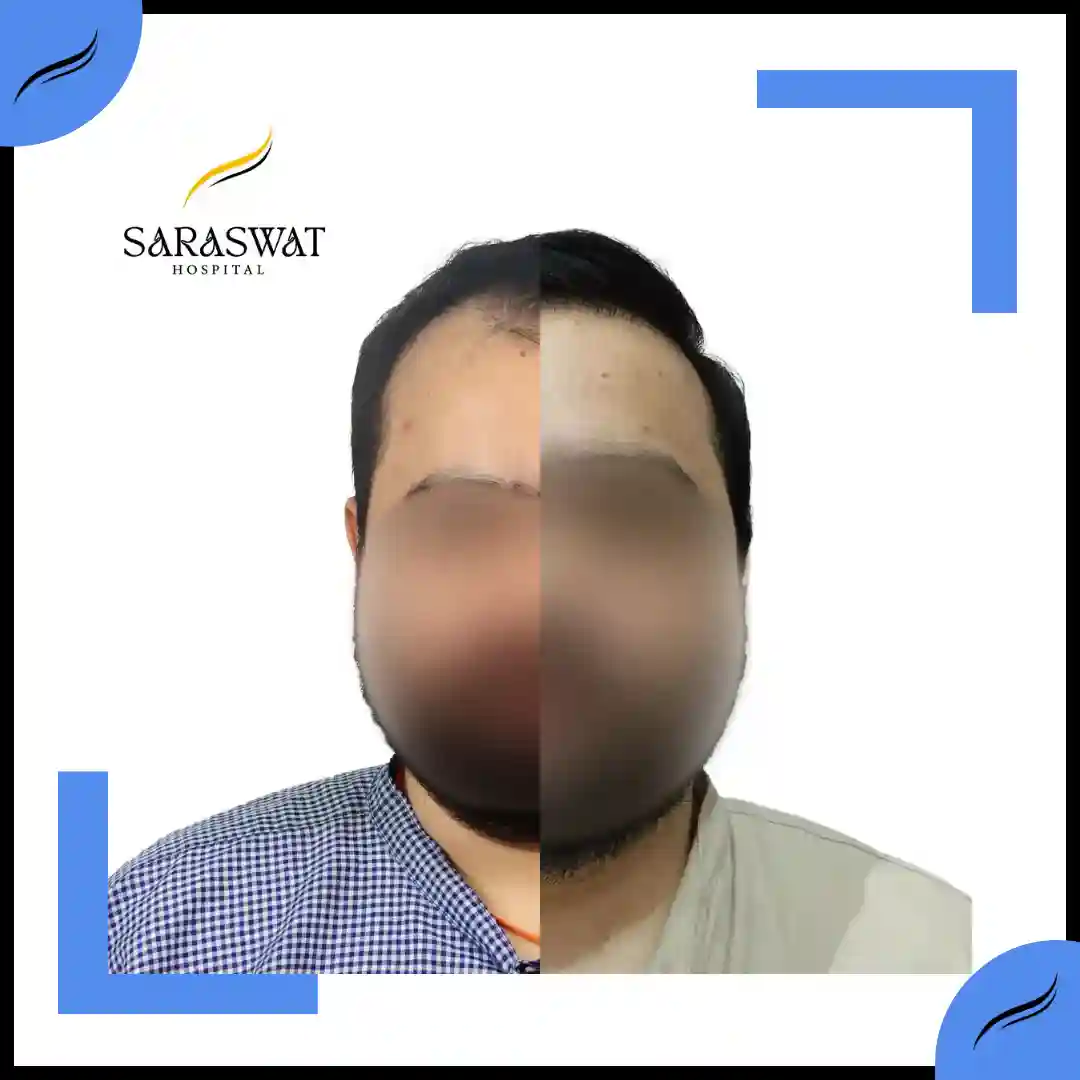 Hair Transplant Before and After