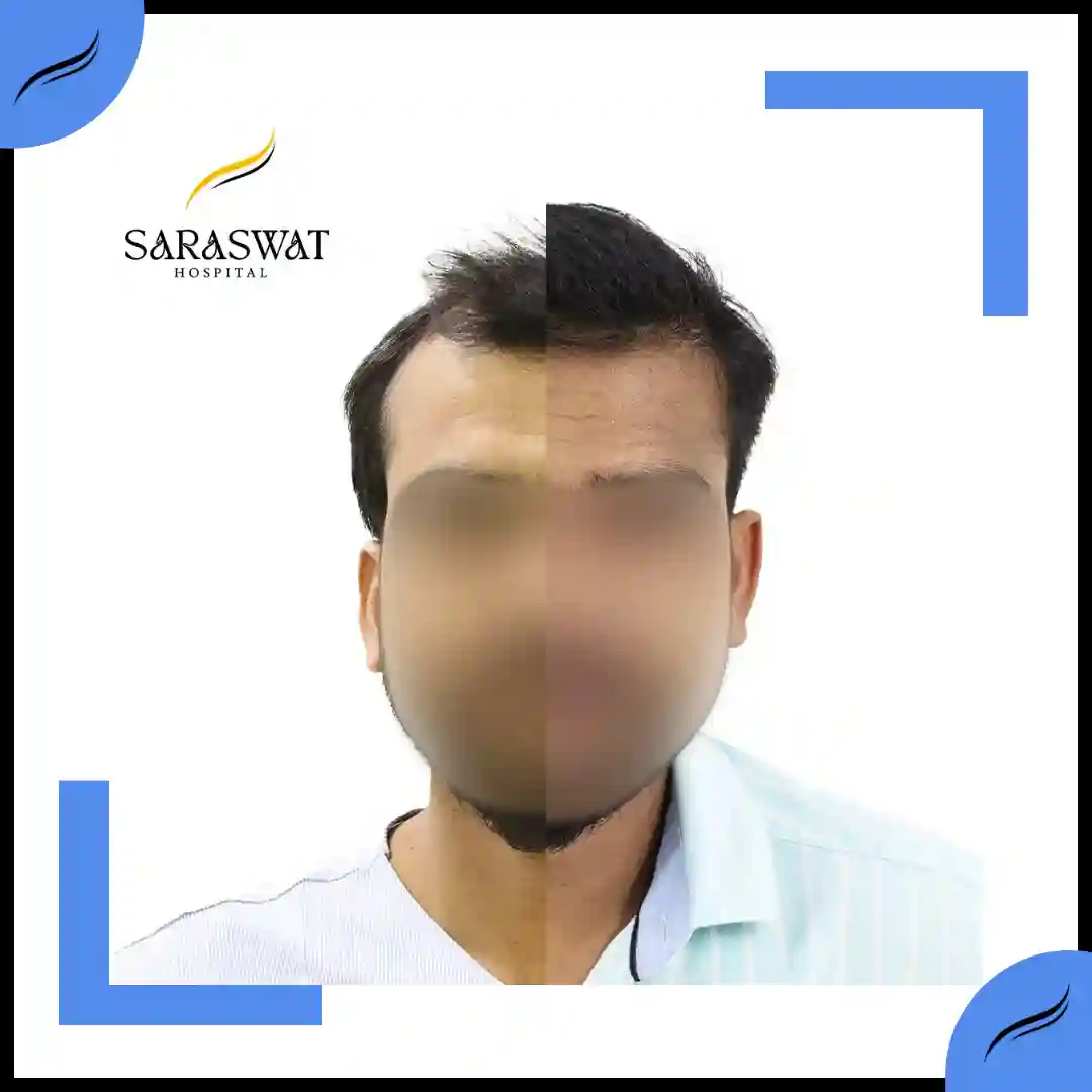 Hair Transplant Before and After