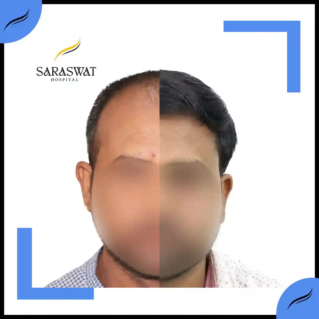 Hair Transplant Before and After | Hair Transplant Results