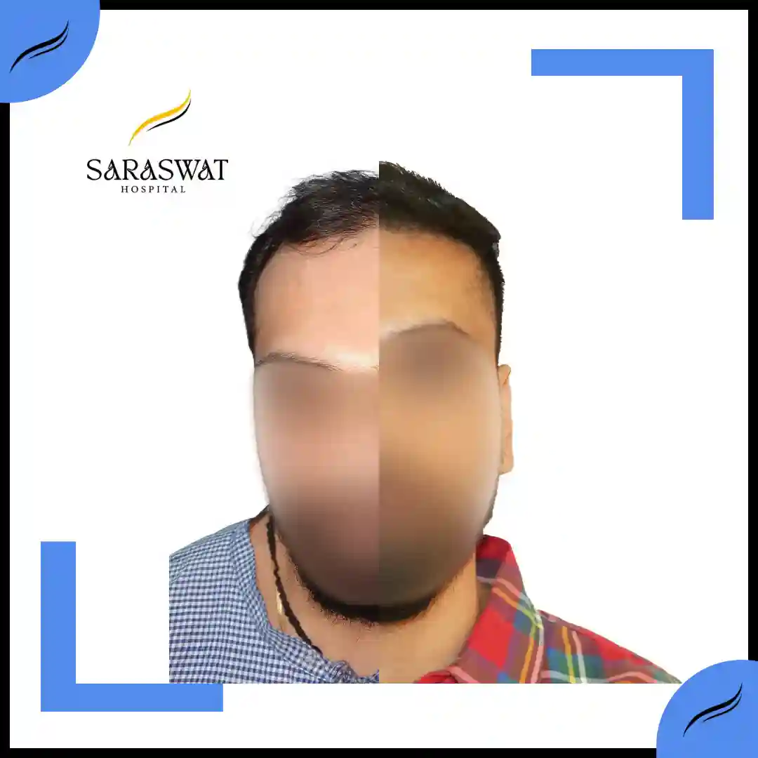 Hair Transplant Before and After | Hair Transplant Results
