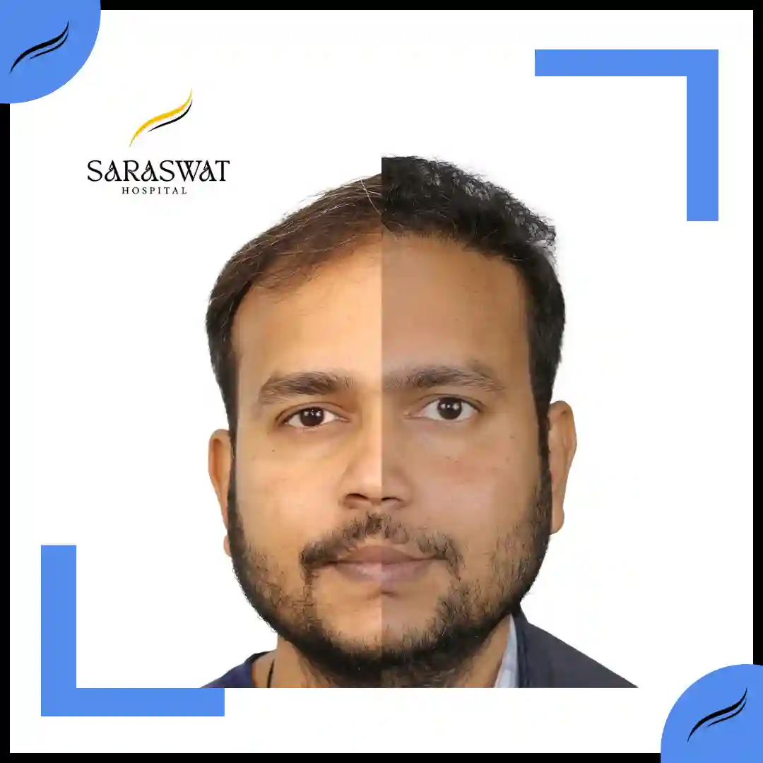 Hair Transplant Before and After | Hair Transplant Results