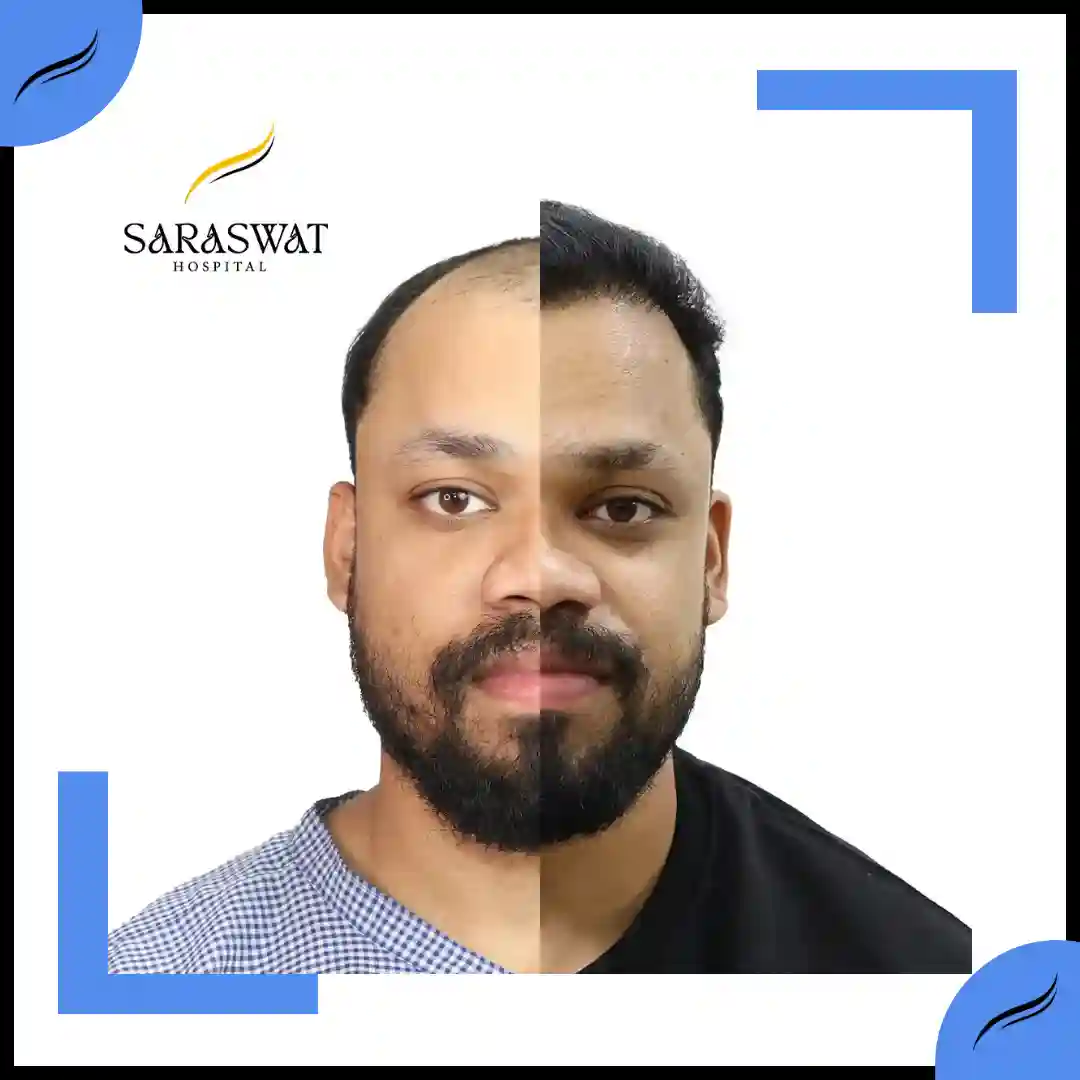 Hair Transplant Before and After | Hair Transplant Results