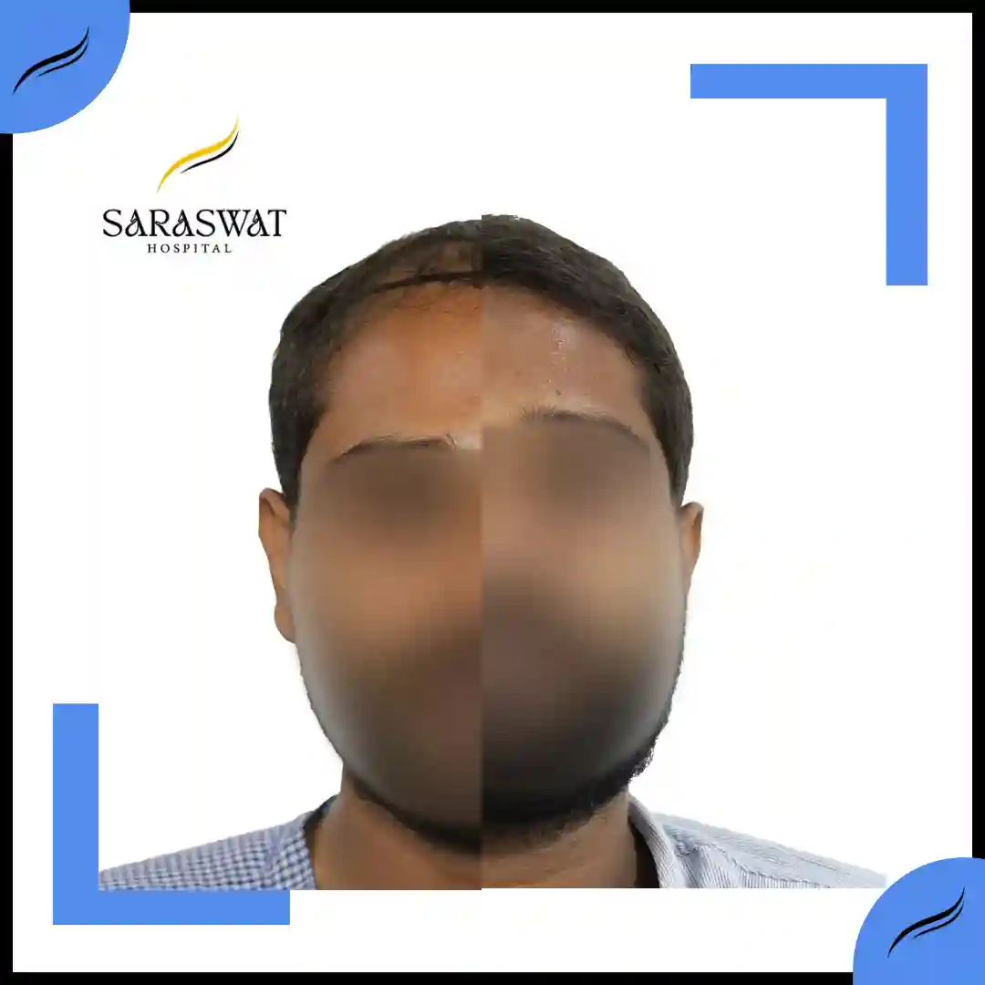 Hair Transplant Before and After | Hair Transplant Results