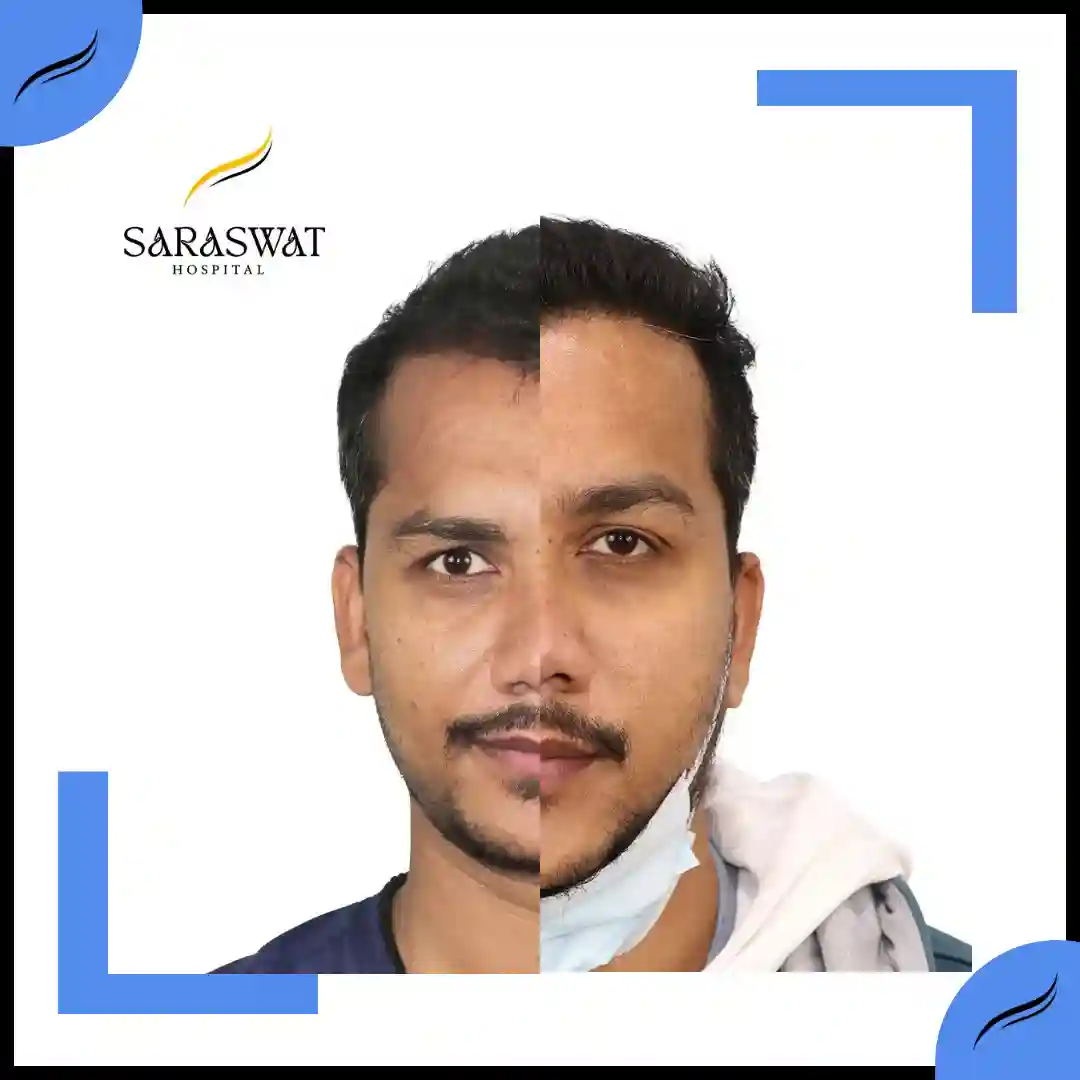 Hair Transplant Before and After | Hair Transplant Results