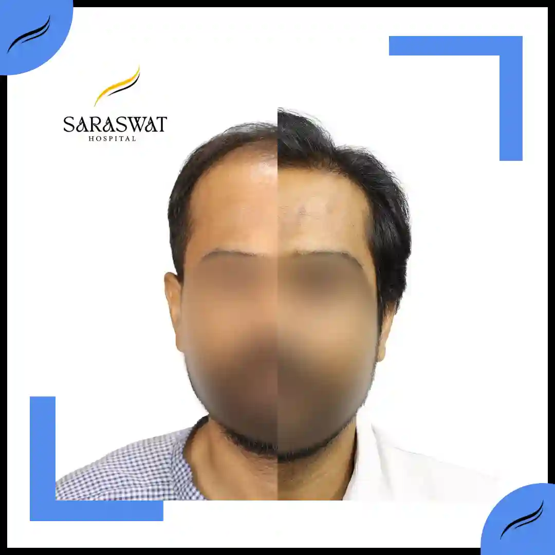 Hair Transplant Before and After | Hair Transplant Results