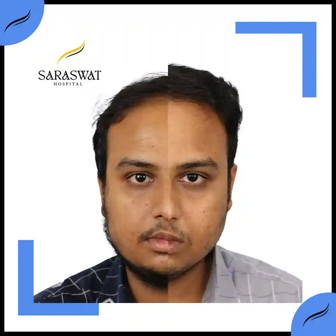 Hair Transplant Before and After | Hair Transplant Results | Hair Transplant Agra