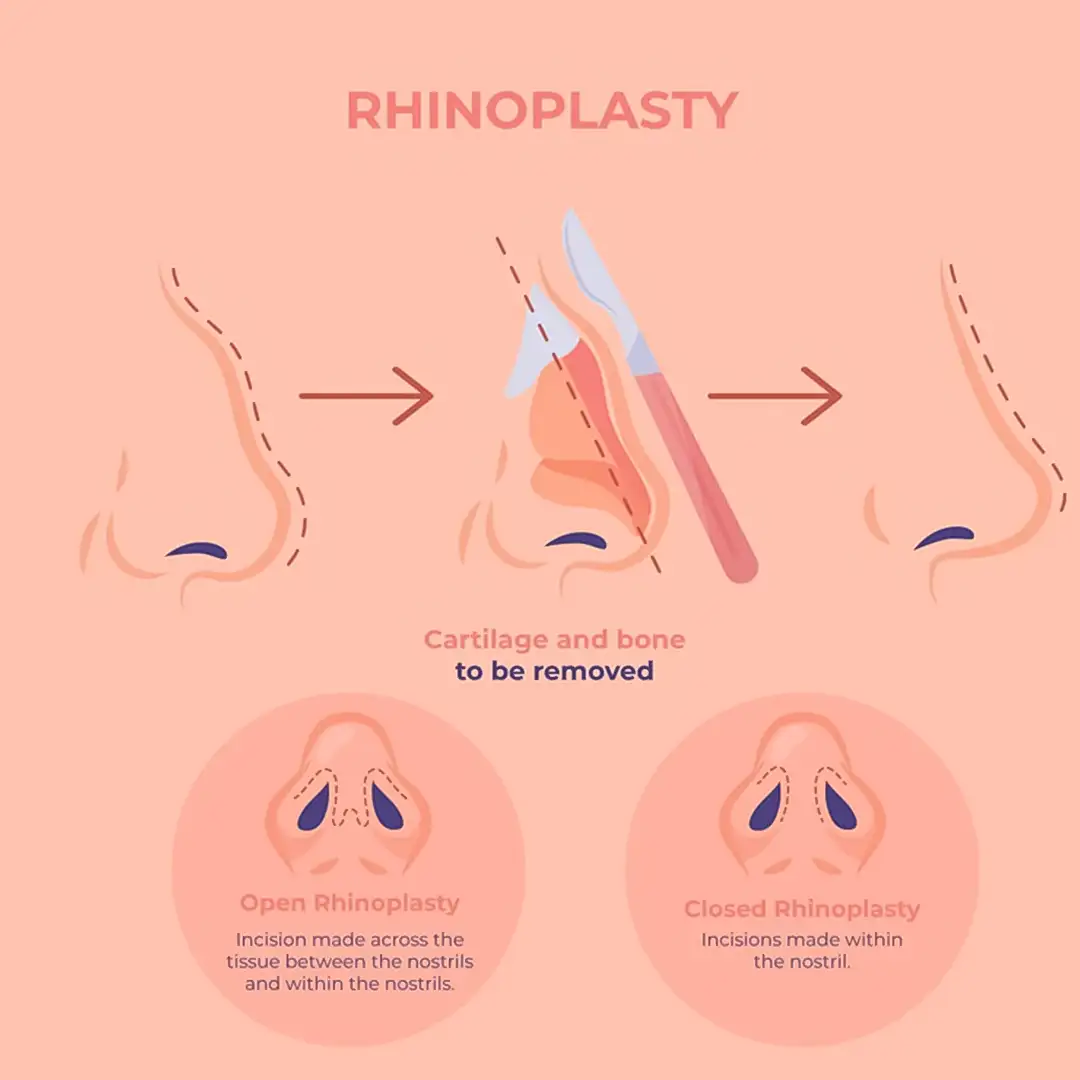 Procedure for Rhinoplasty