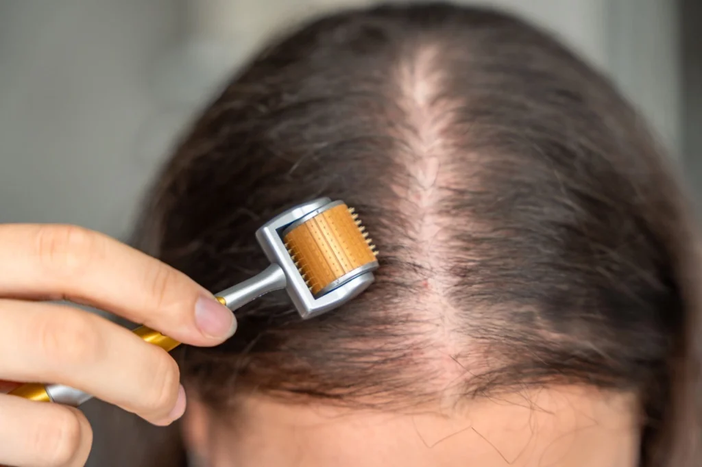 Side effects of Derma Roller for Hair