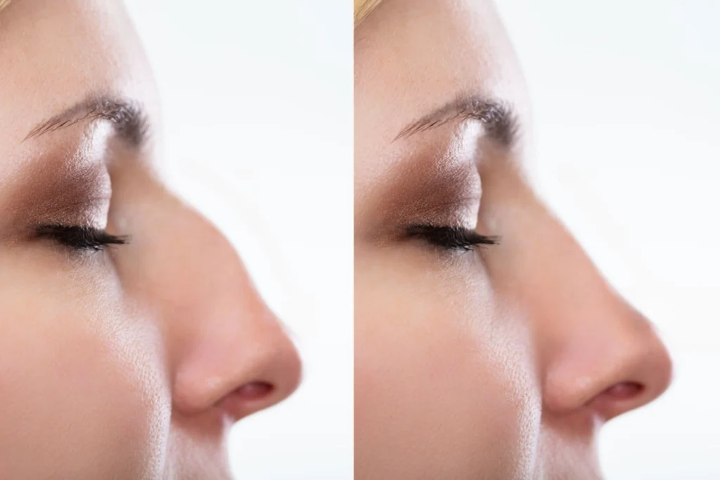 Side By Side Comparison of Rhinoplasty