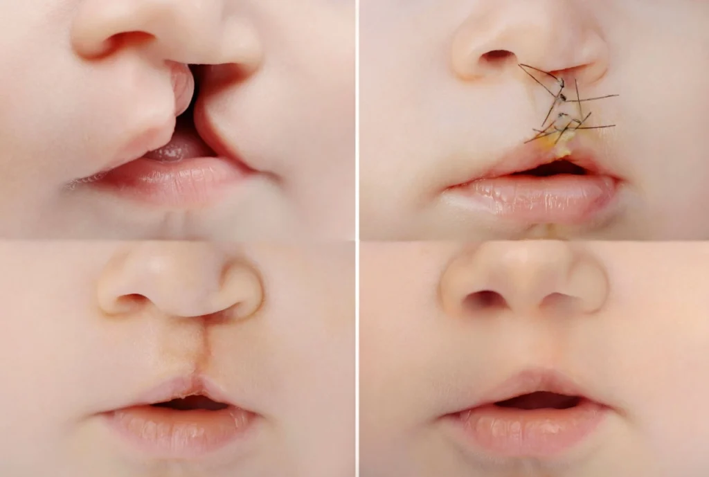 Causes of Cleft Lip and Cleft Palate