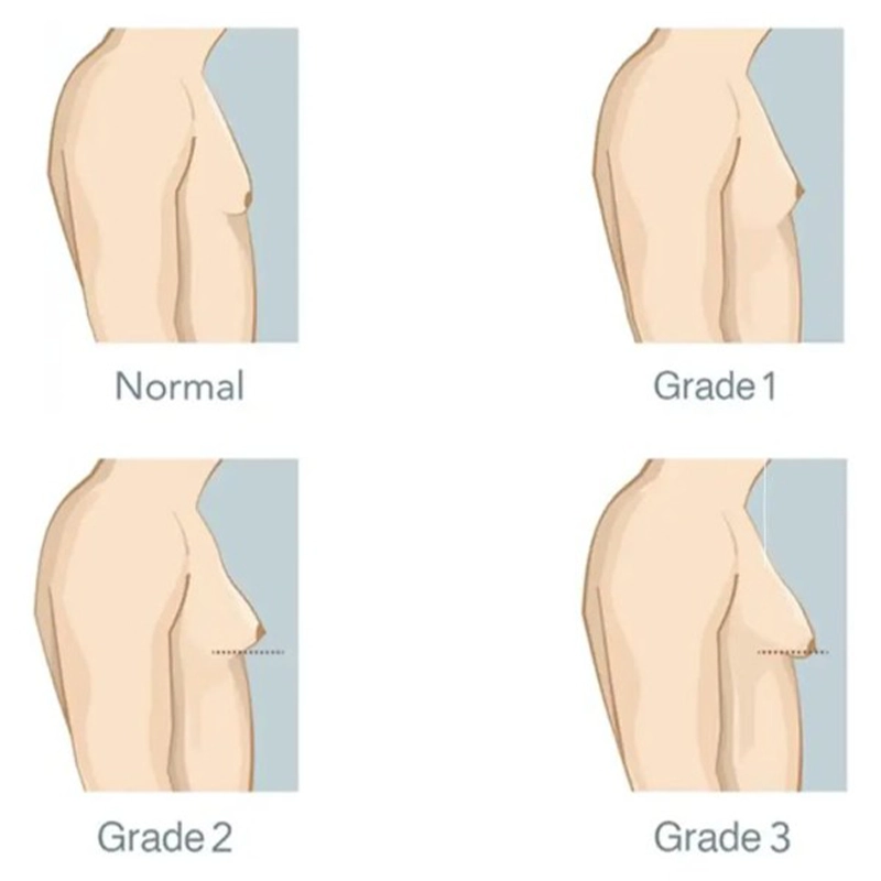 Gynecomastia Surgery
