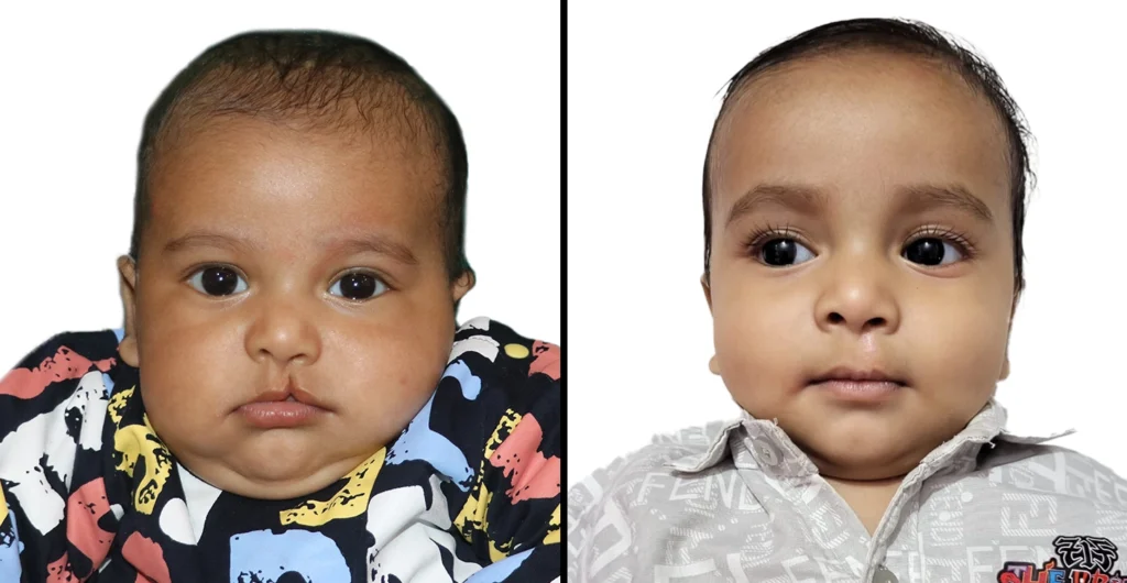 Cleft Lip and Palate: Causes, Symptoms, and Treatment
