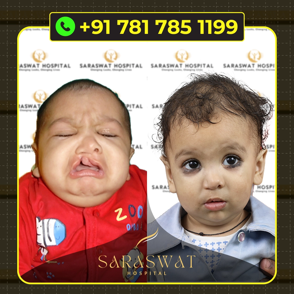 Best Cleft Lip and Palate Hospital in India