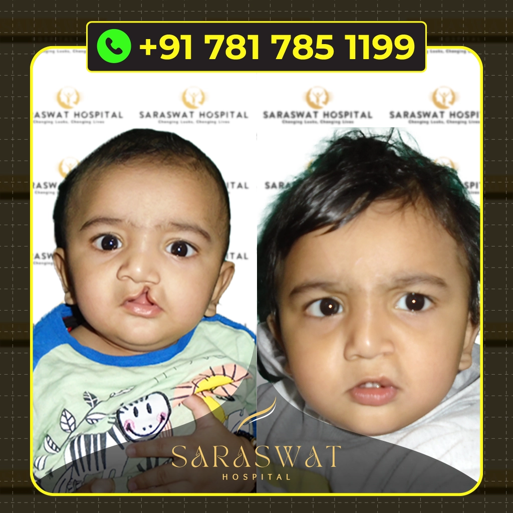 Best Cleft Lip and Palate Hospital in India