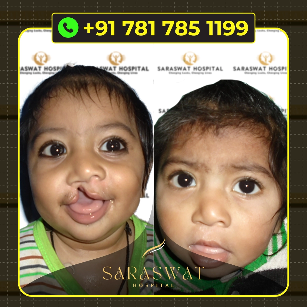 Best Cleft Lip and Palate Hospital