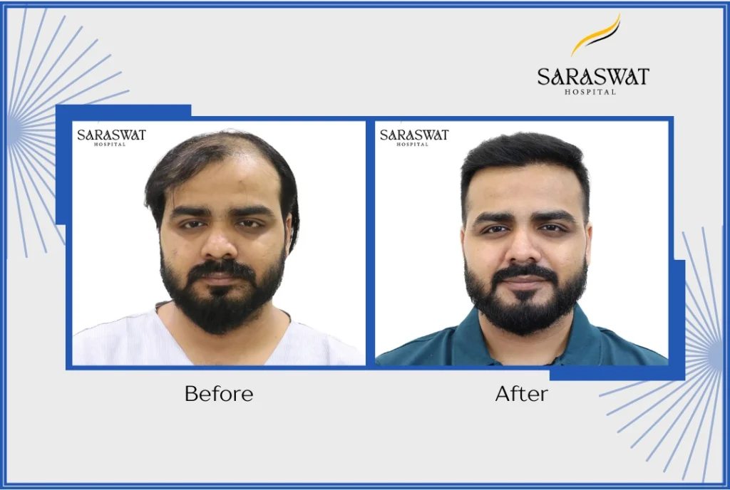 Best Hair Transplant Result