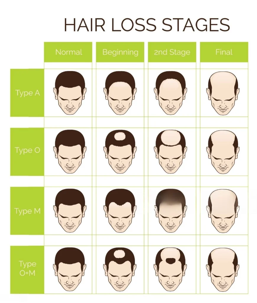 Receding Hairline Stages