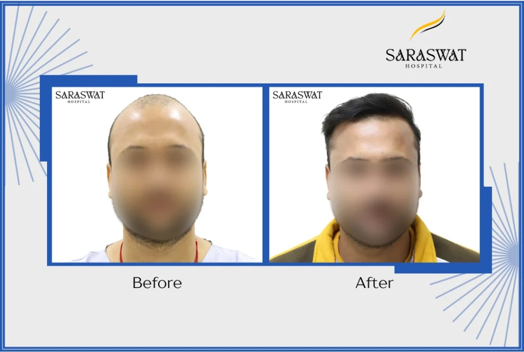 Hair Transplant Before and After
