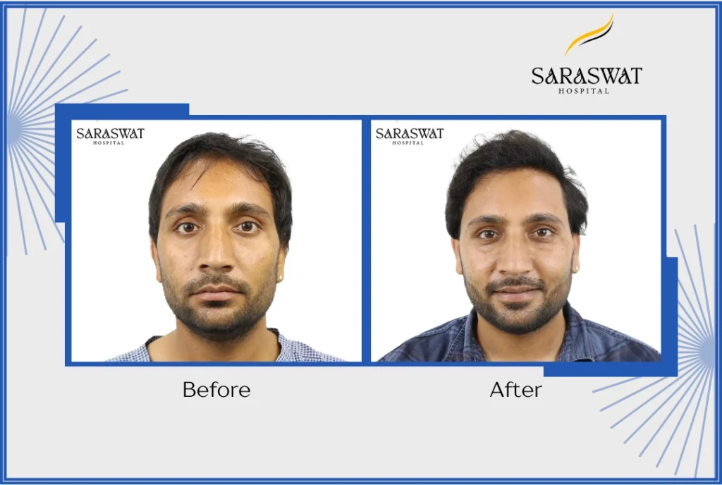 Guidelines for Hair Transplants in India