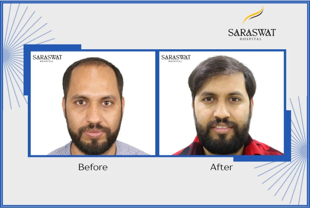 Top Hair Transplant Clinics in India