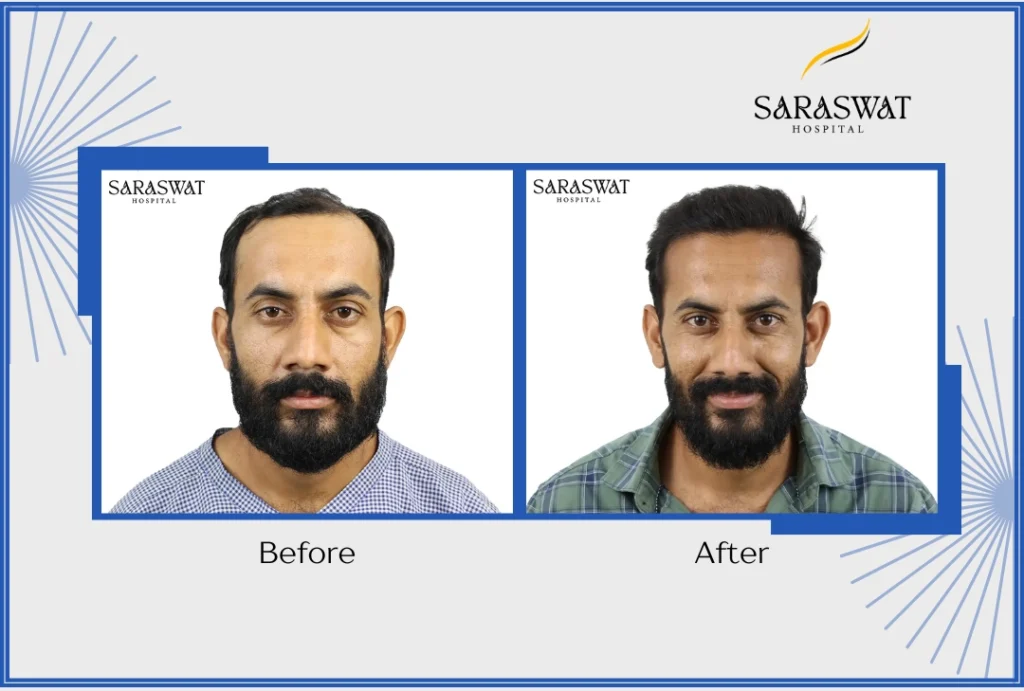 Is Hair Transplant 100% Successful?