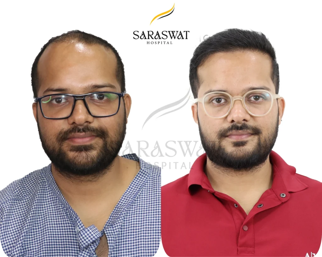 Hair Transplant Before and After