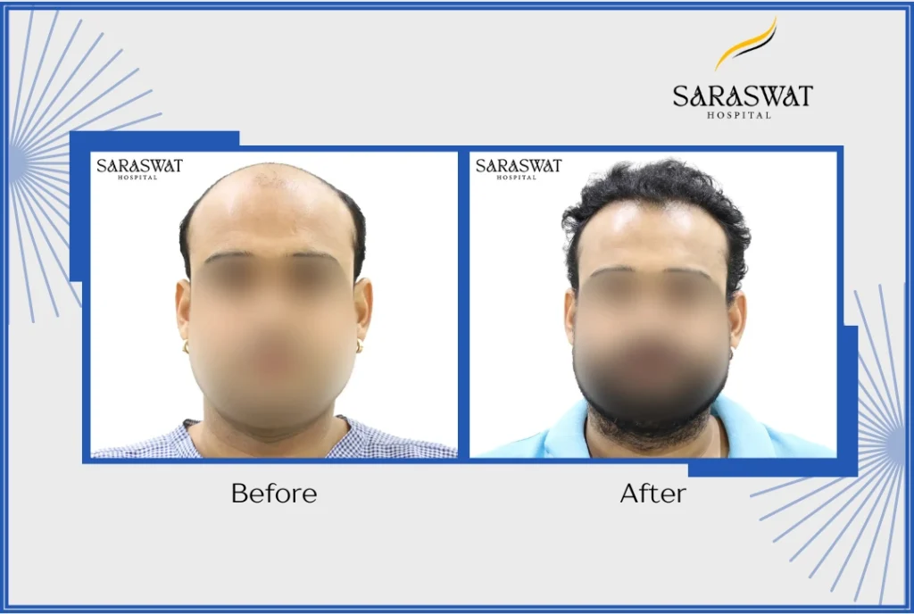 Why Hair Transplant Clinics in India Attract International Patients?