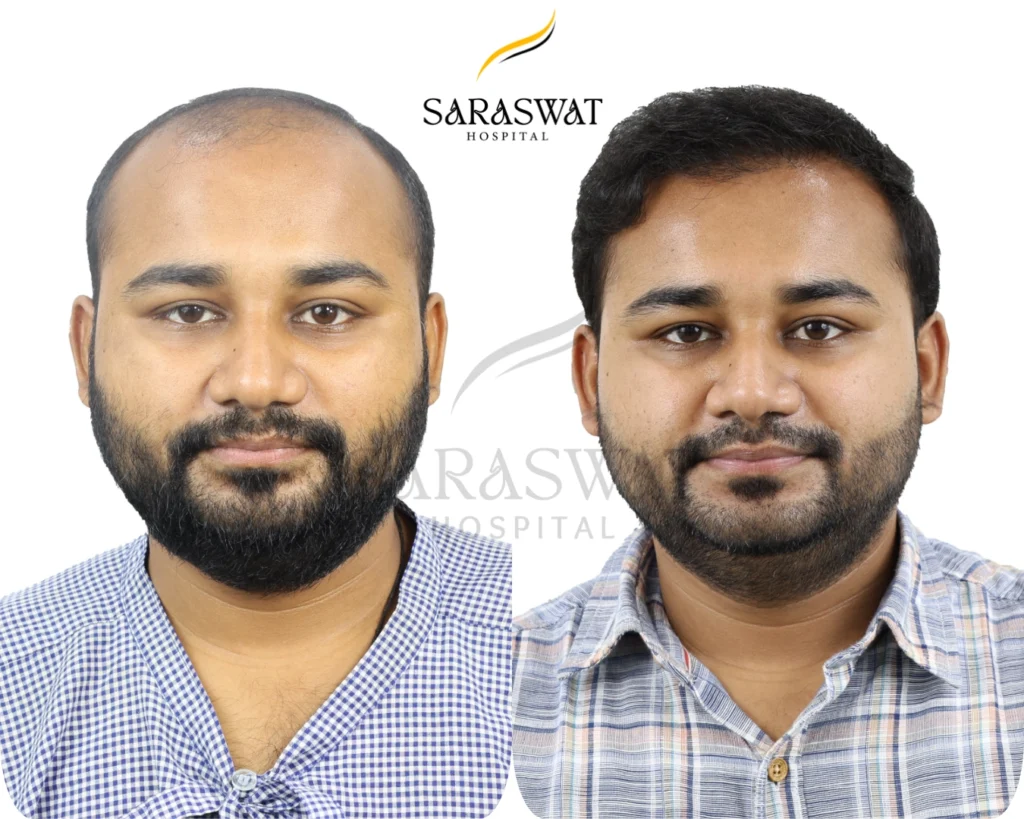 Hair Transplant Before and After