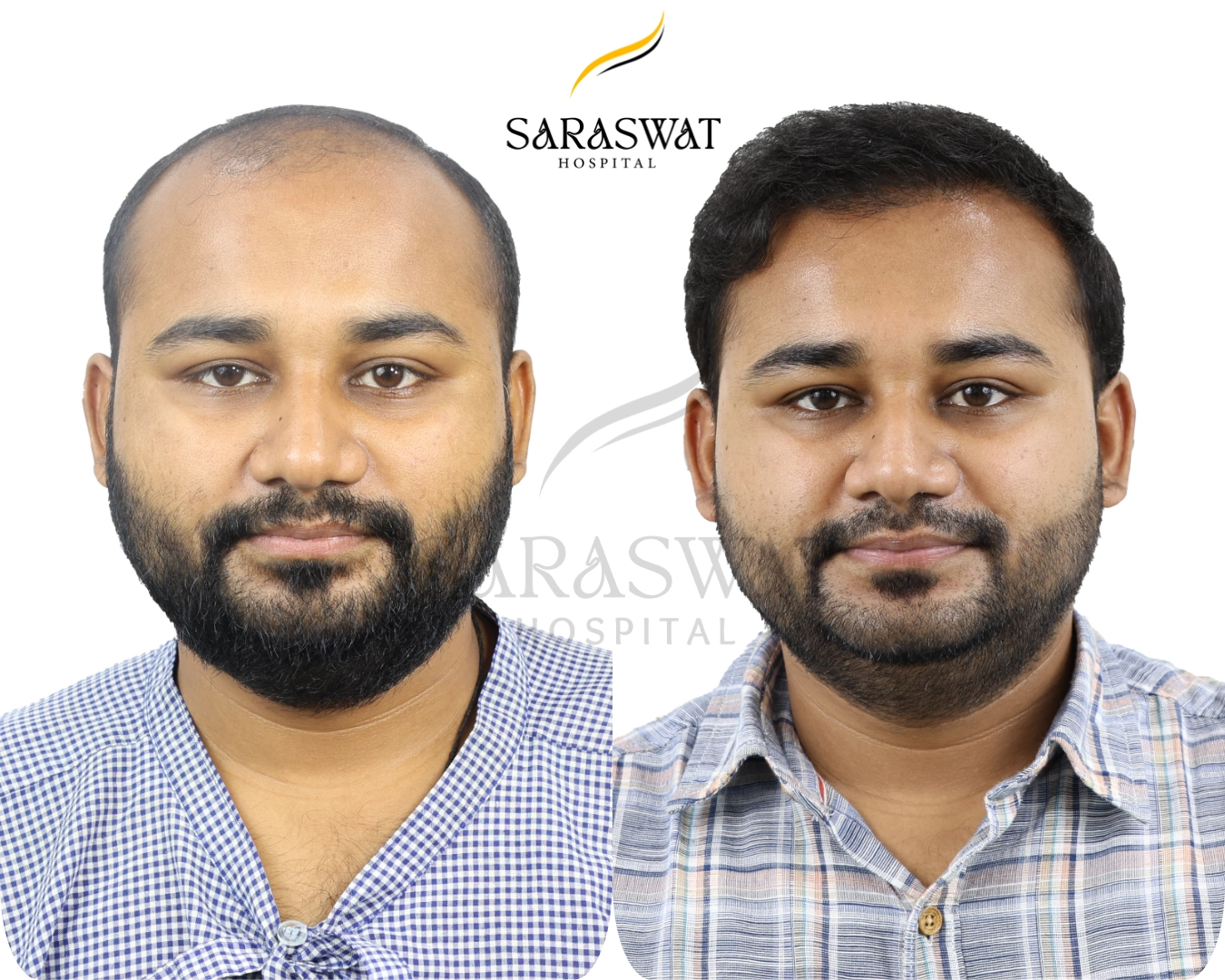 Hair Transplant Before and After
