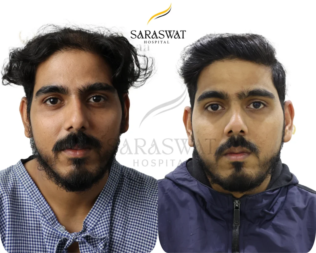 Hair Transplant Before and After